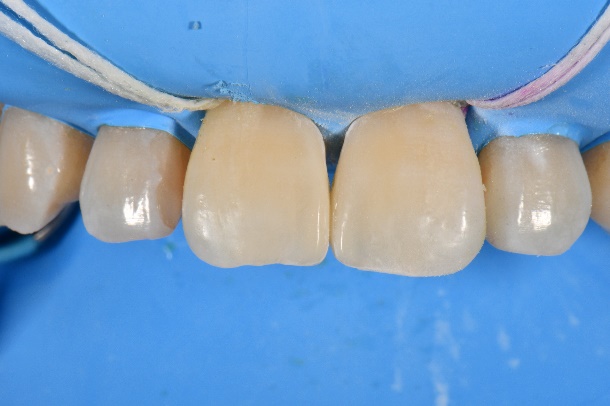 すきっ歯のケース 3