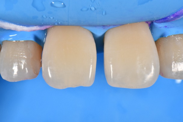 すきっ歯のケース 2