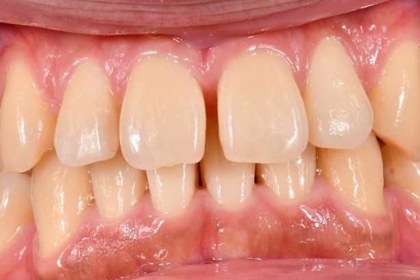 すきっ歯のケース 1
