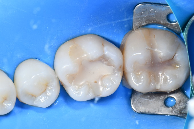 奥歯のケース1