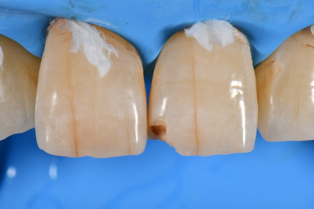 前歯のケース1