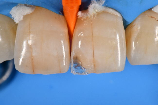 前歯のケース2